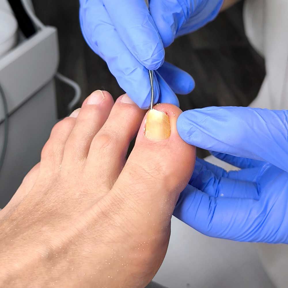 A master podiatrist treats an ingrown toenail 