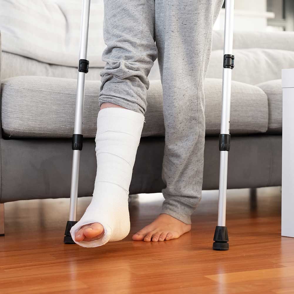 Woman with leg in gypsum plaster on elbow crutches