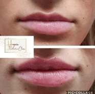 Lip Enhancement