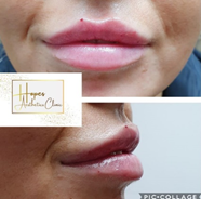 Lip Projection