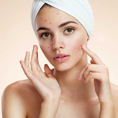 Best facial treatments for acne in London