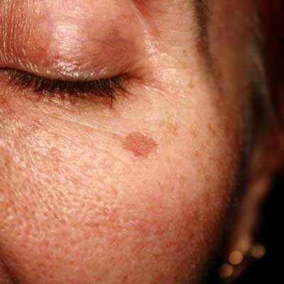 Best facial treatments for age spots in London