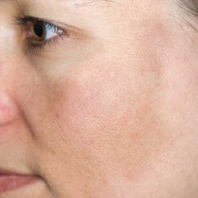 Best facial treatments for pigmentation in London