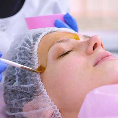 Chemical facial peels treatments in London
