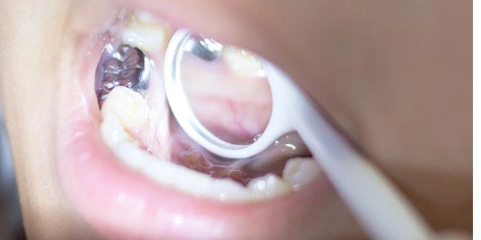 Stainless Steel Crowns