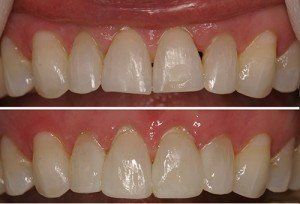 Before And After Teeth Fixing and Cleaning — Wilmington, DE — New Concept Dental