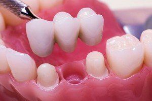 Adding Single Tooth Denture — Wilmington, DE — New Concept Dental