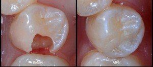 Break Tooth Before And After Fix — Wilmington, DE — New Concept Dental