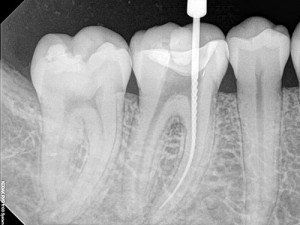 Root Canal X-ray — Wilmington, DE — New Concept Dental
