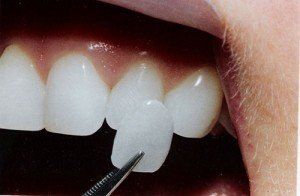 Covering Tooth — Wilmington, DE — New Concept Dental