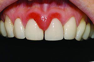 Swelling Gum — Wilmington, DE — New Concept Dental