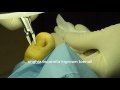 unghia incarnita - uña encarnada - ingrown toenail treatment podologo