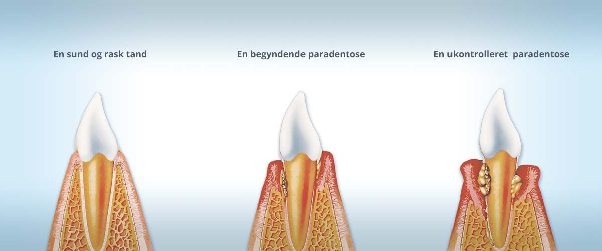 Et diagram, der viser stadierne af tandforfald
