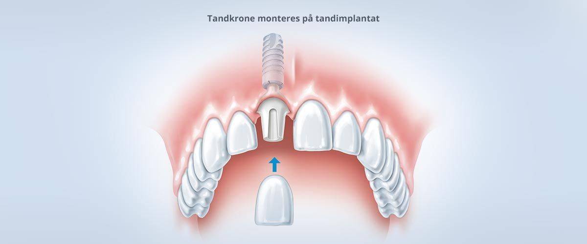En illustration af et tandimplantat i en mund