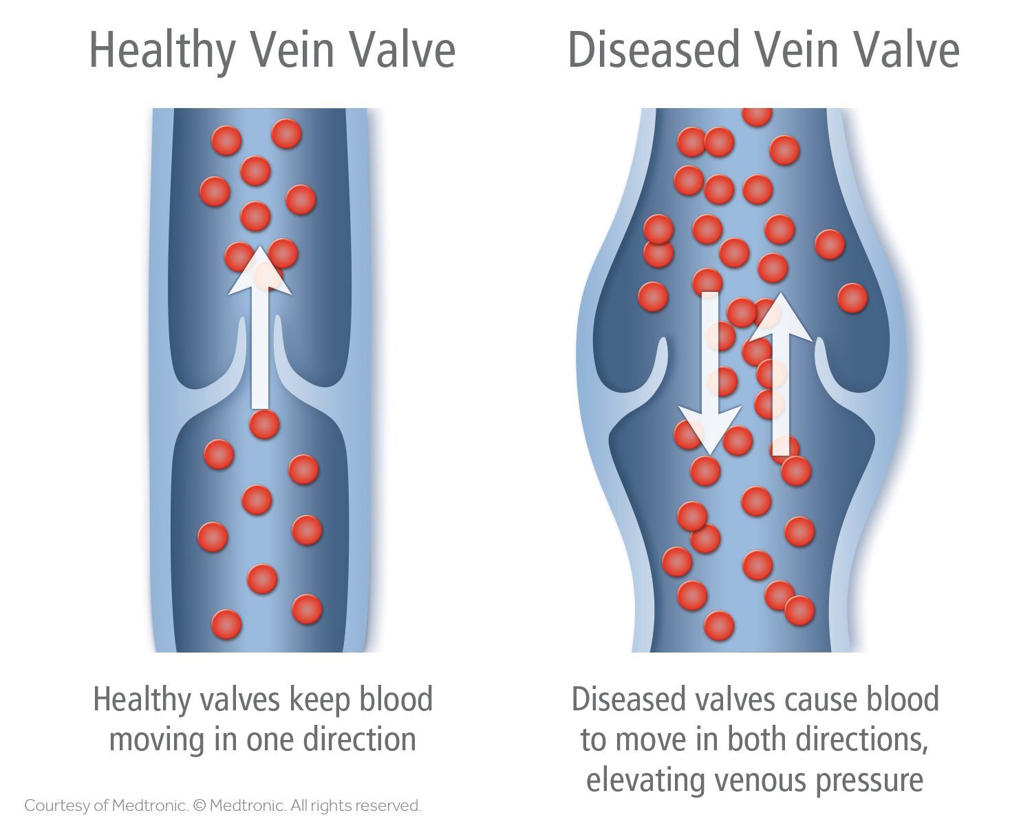 healthy vs diseased vein valve