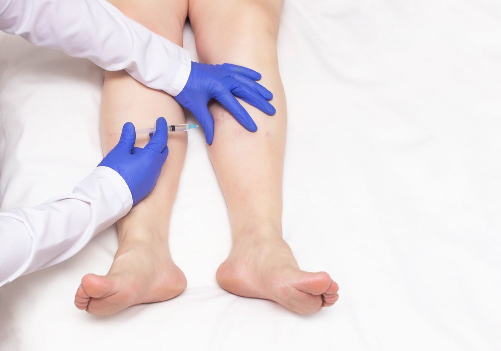 SCLEROTHERAPY