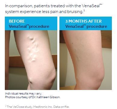 VenaSeal Before and After