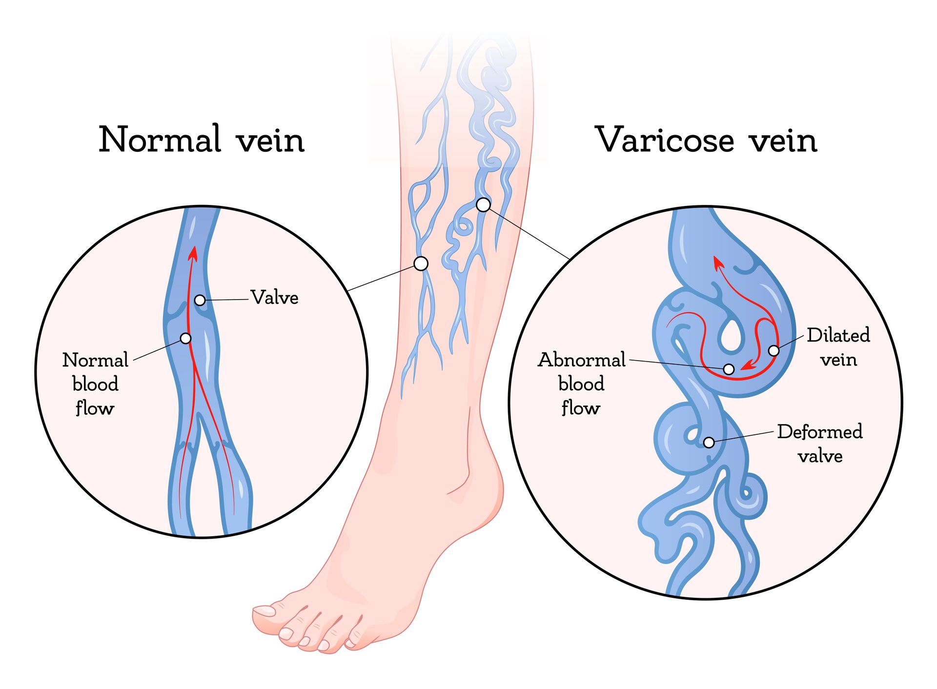how do varicose veins form