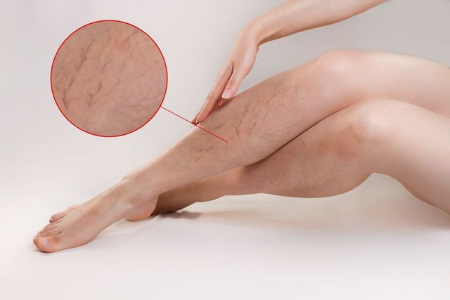Are Your Varicose Veins a Sign of Deeper Trouble?: Upper East Side  Cardiology: Cardiovascular Disease Specialists