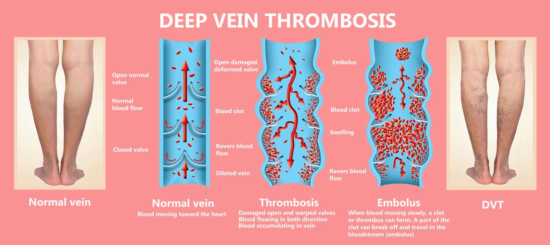 Venous Thrombosis Causes Symptoms Prevention And Treatments