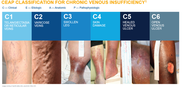 Patient Guide to Chronic Venous Insufficiency - Tactile Medical