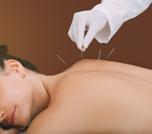 A woman is getting acupuncture on her back