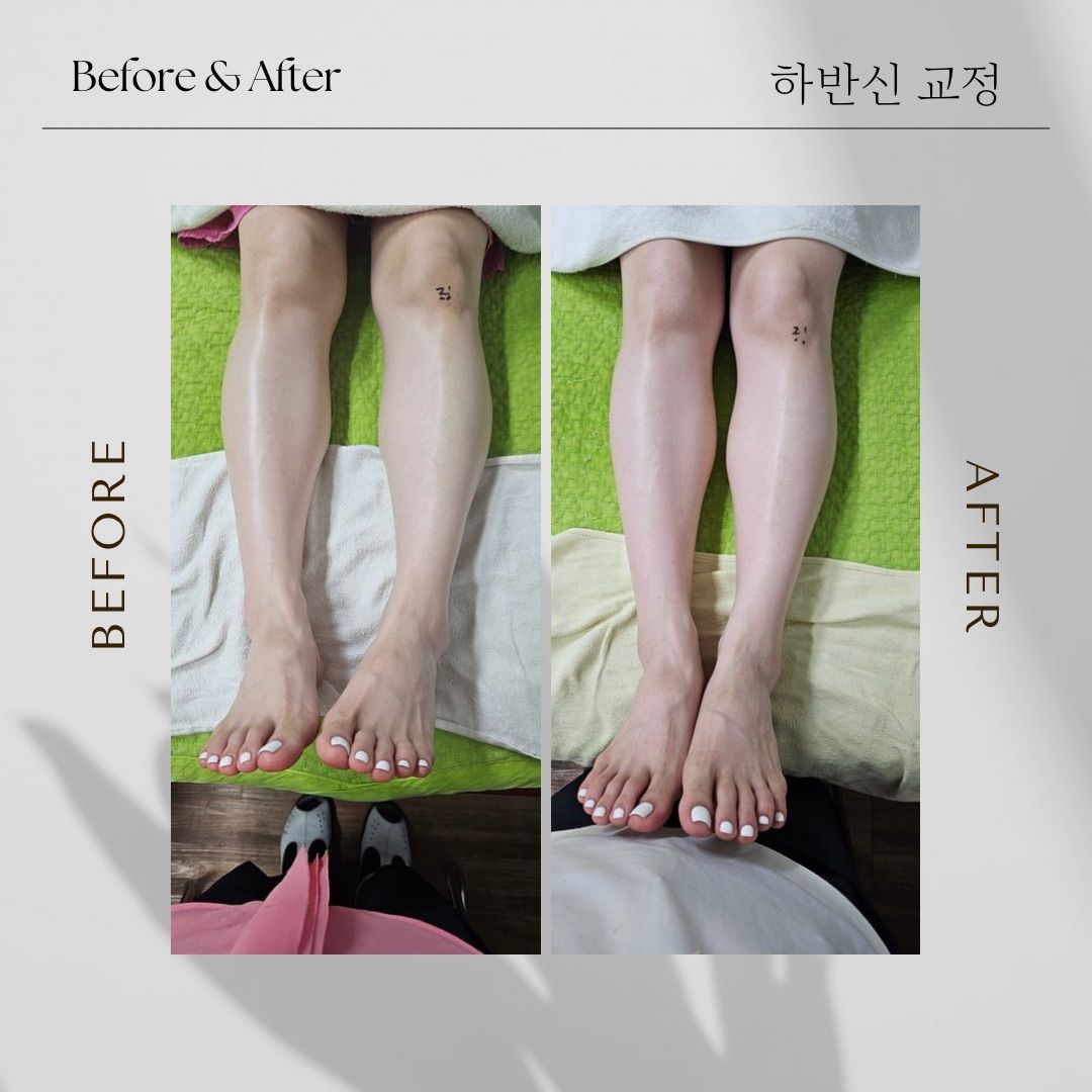 겨울철 혈액순환을 돕는 꼼꼼한 발지압 관리 시술 장면