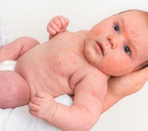 Eczema and the Infant Microbiome