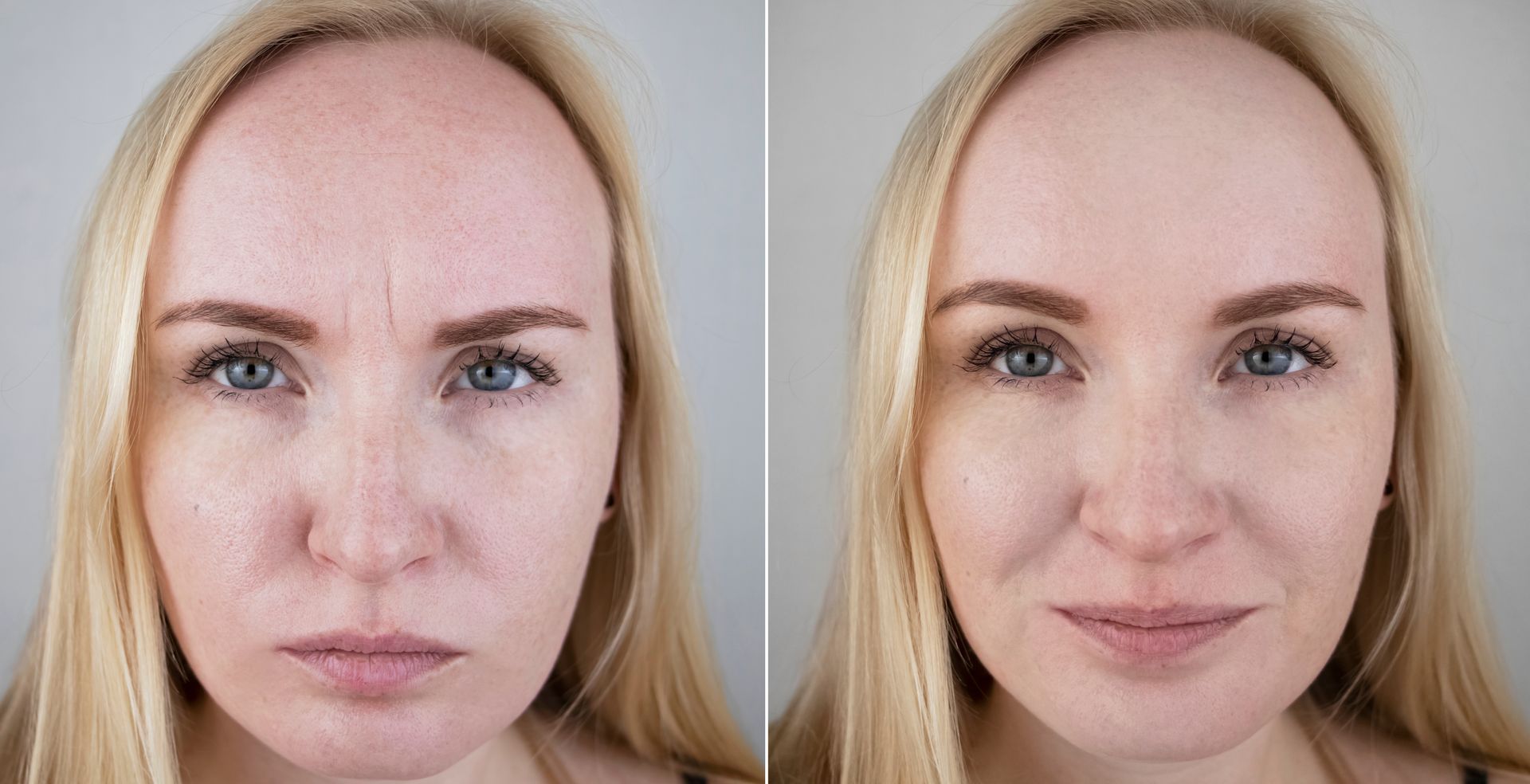 Before and after photos showcasing frown Botox treatment for reducing forehead wrinkles.