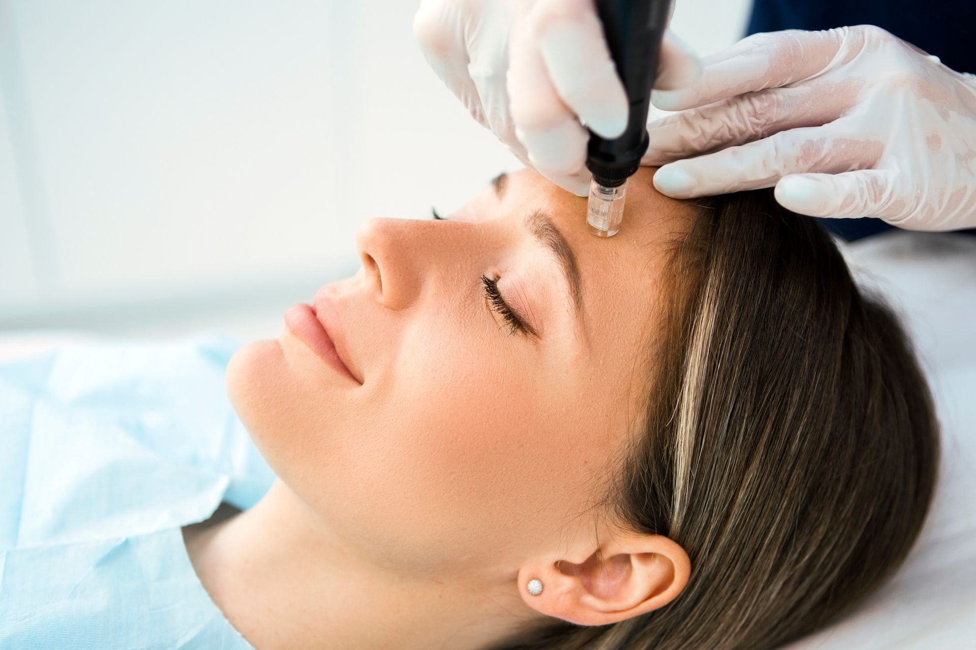 Woman receiving micro-needling treatment on her forehead at a clinic, eyes closed, medical gloves visible.