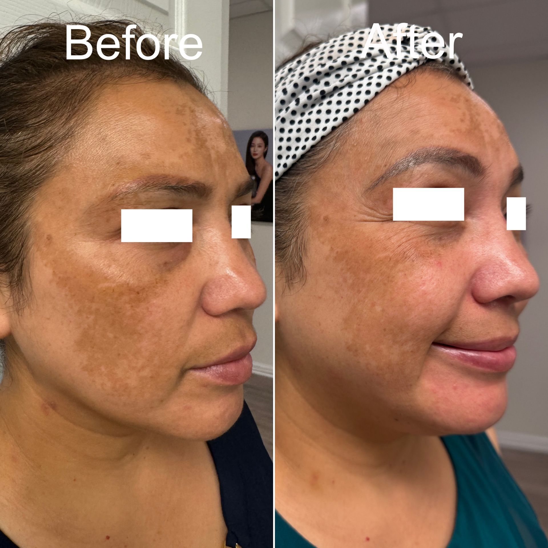 Microneedling Befor & After Results