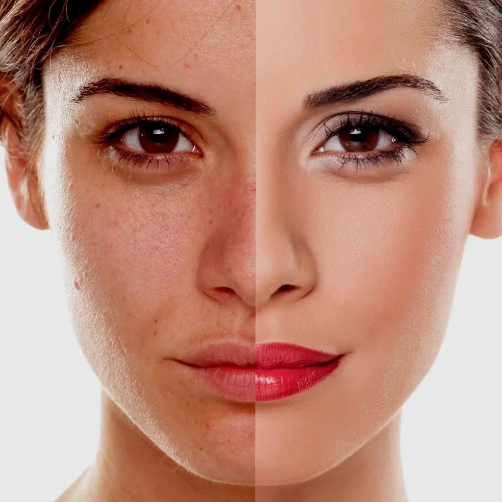 Before and after photos showcasing frown Botox treatment for reducing forehead wrinkles.