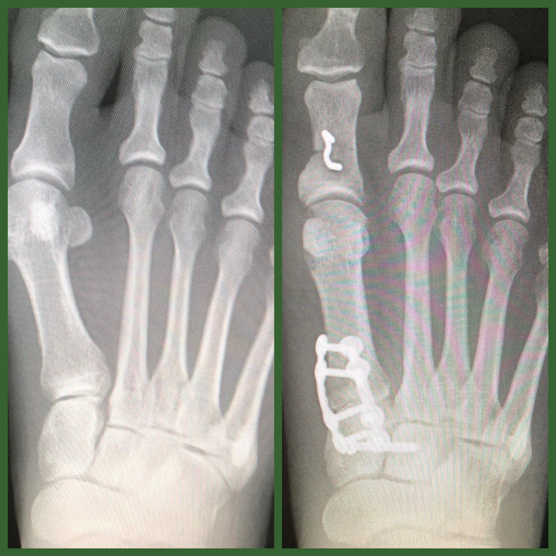 A pair of x-rays of a person 's hand and foot