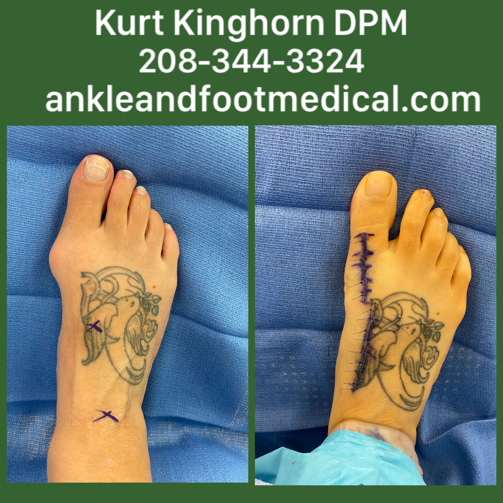 A picture of a person 's foot before and after surgery