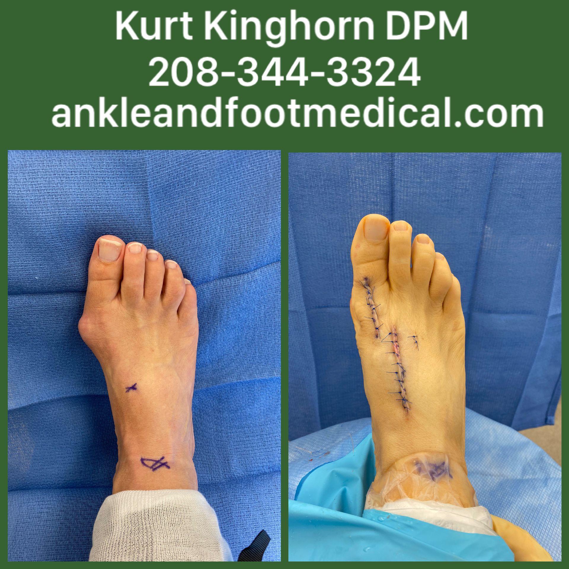 A picture of a person 's foot before and after surgery