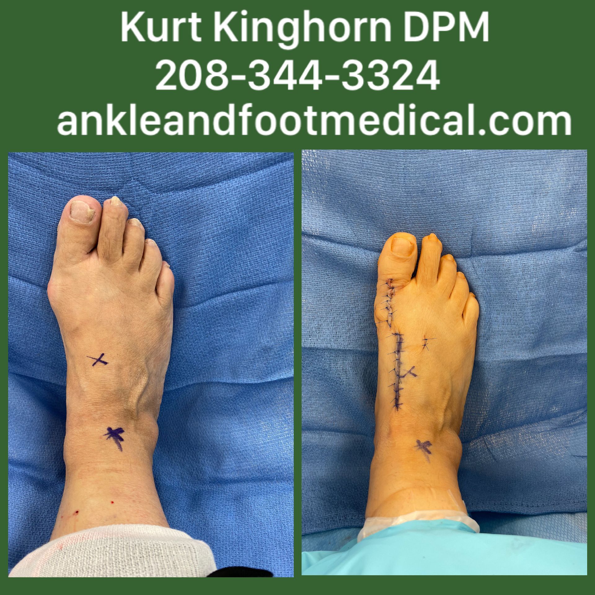 A picture of a person 's foot before and after surgery