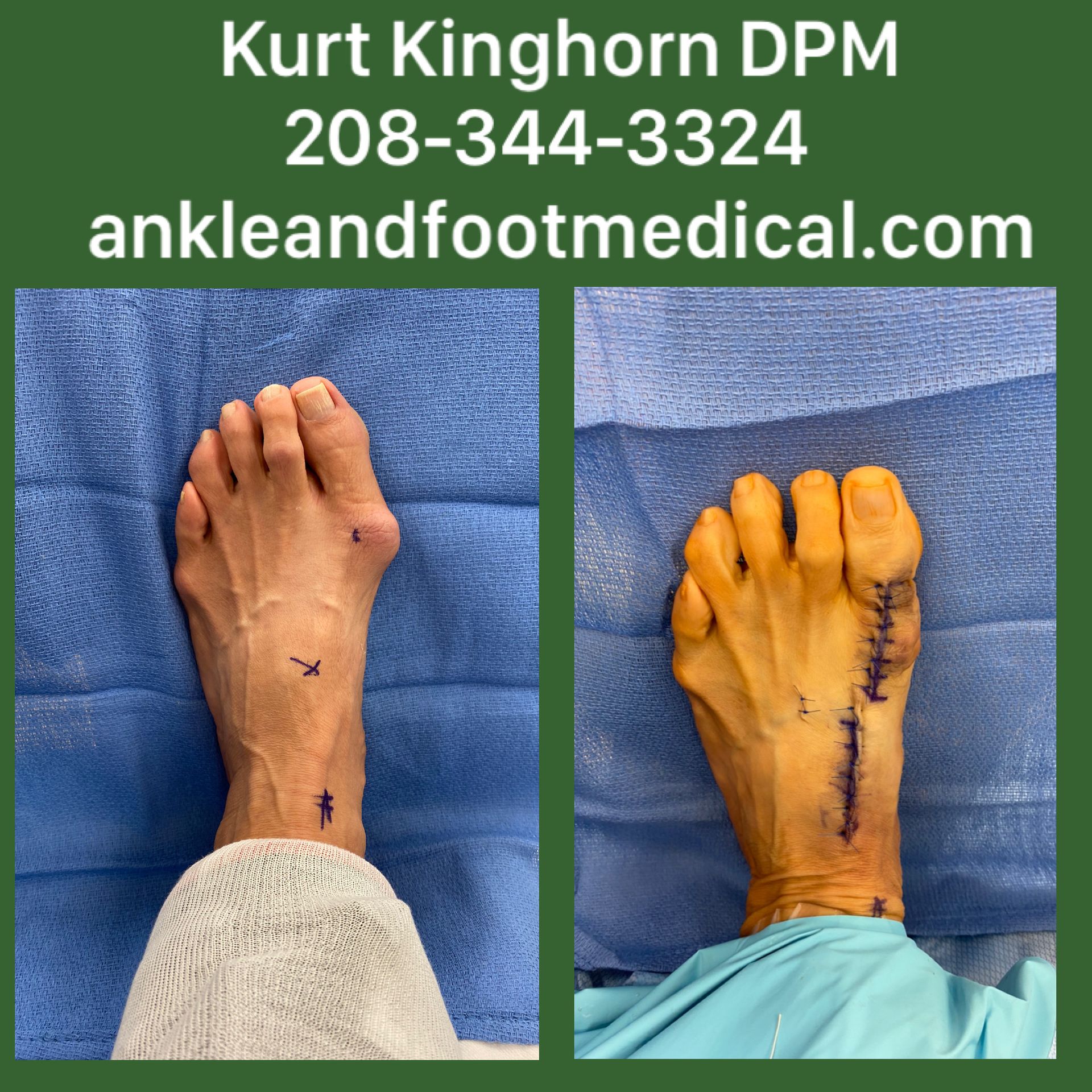 A picture of a person 's foot before and after surgery