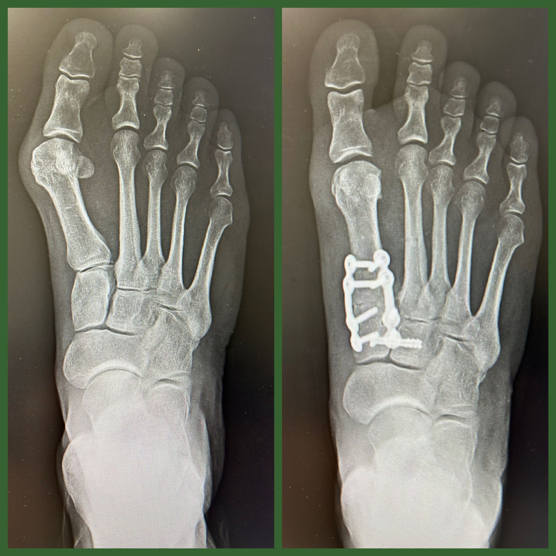 An x-ray of a person 's foot before and after surgery