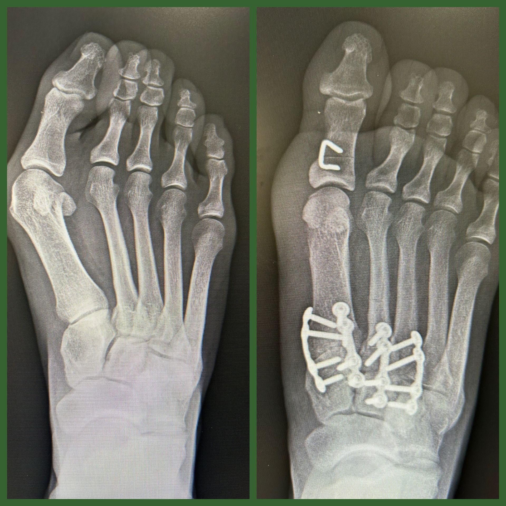 An x-ray of a person 's foot before and after surgery