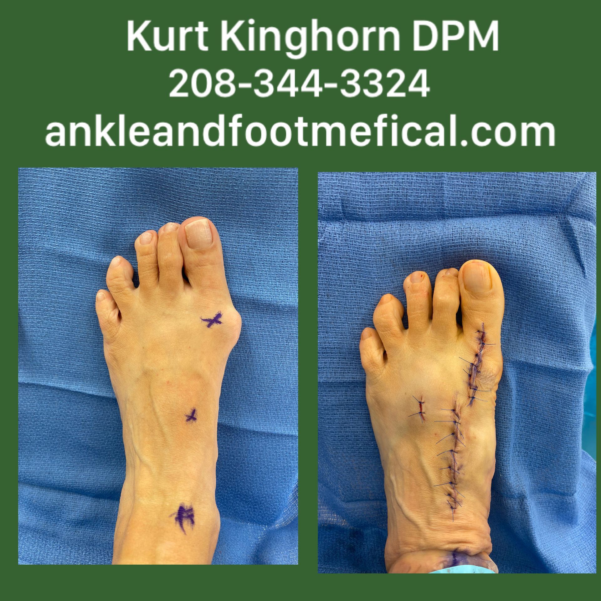A picture of a person 's foot before and after surgery