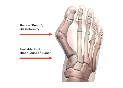 A skeleton of a foot with an arrow pointing to a bunion