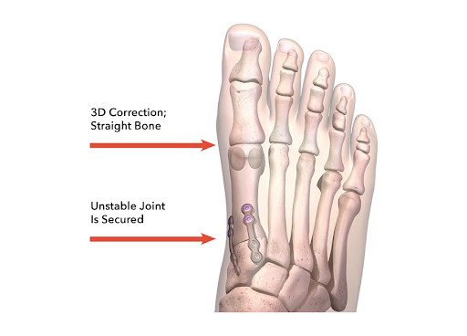 A diagram of a foot with a straight bone and an unstable joint.