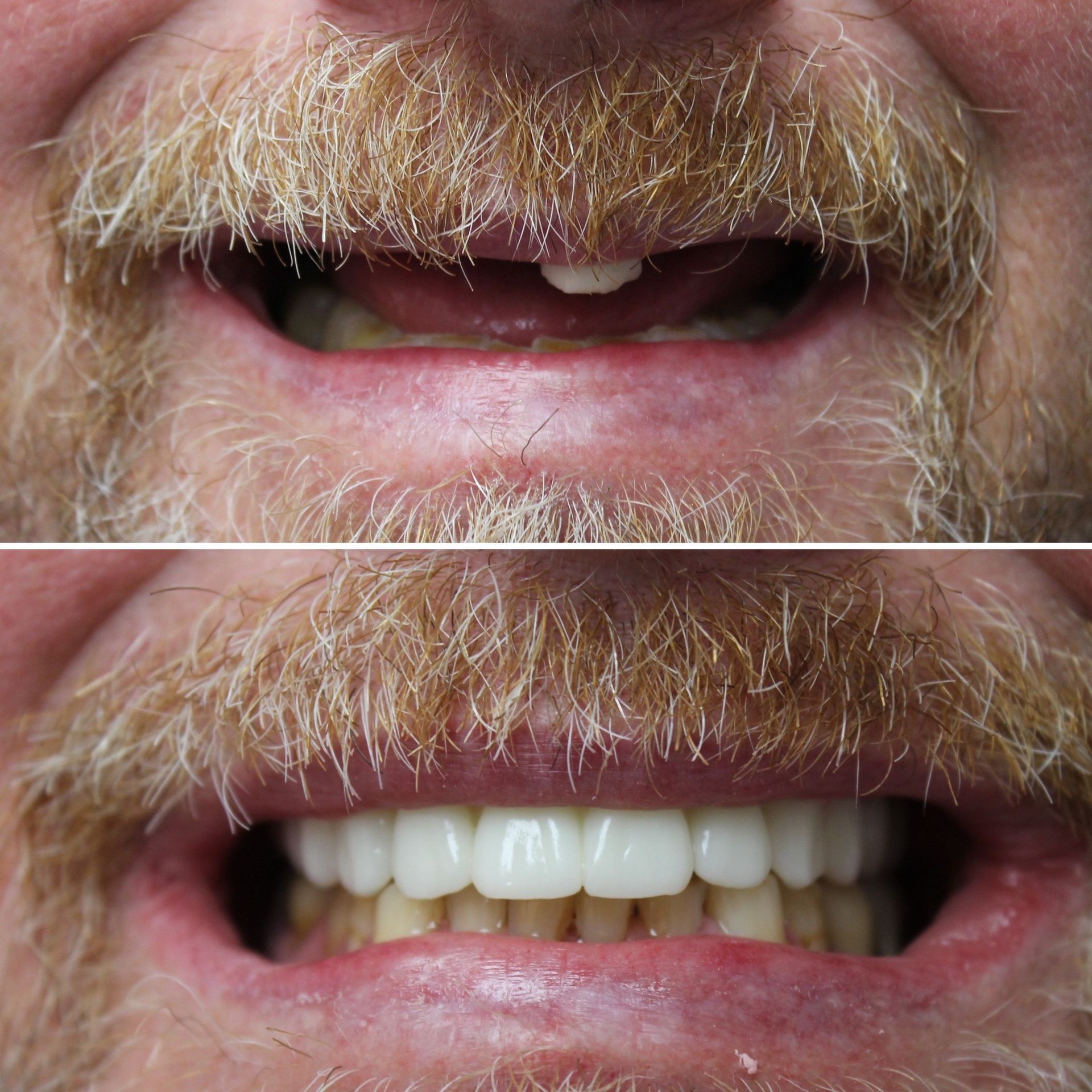 A man with a beard has a before and after picture of his teeth.