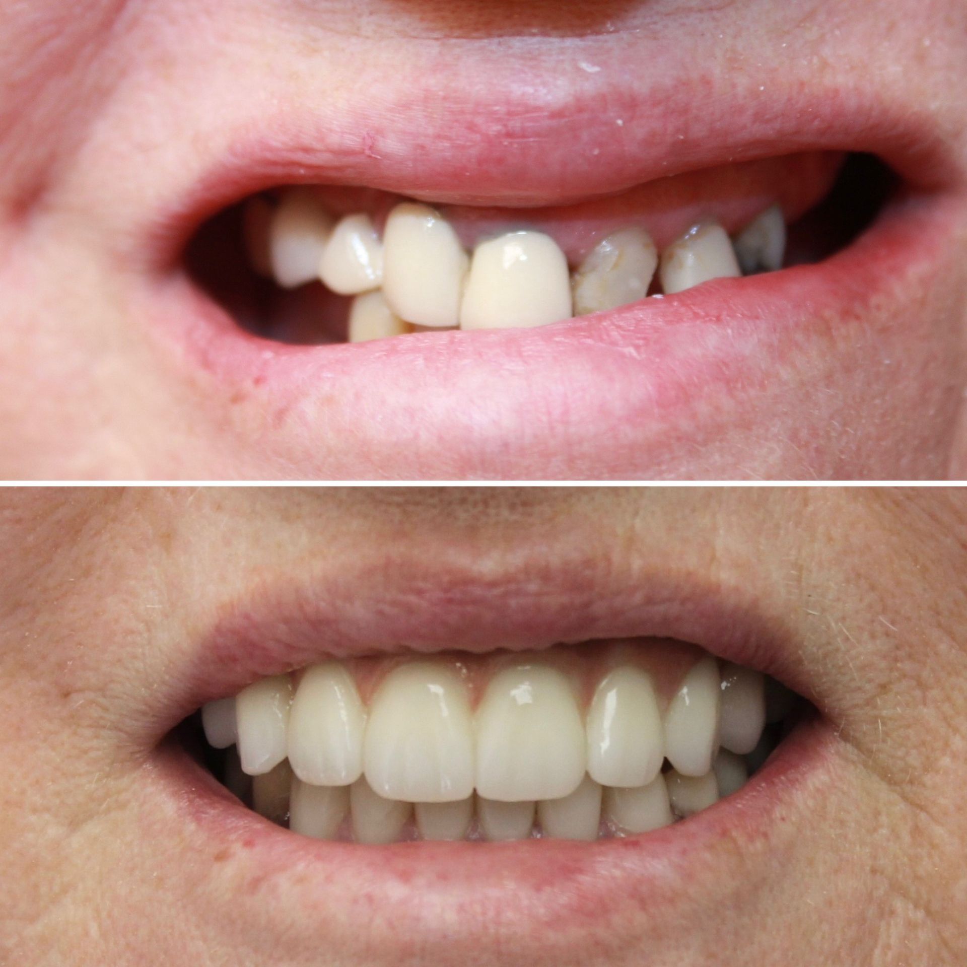 A before and after picture of a person 's teeth