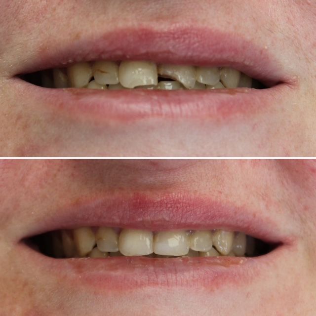 A before and after picture of a woman 's teeth.