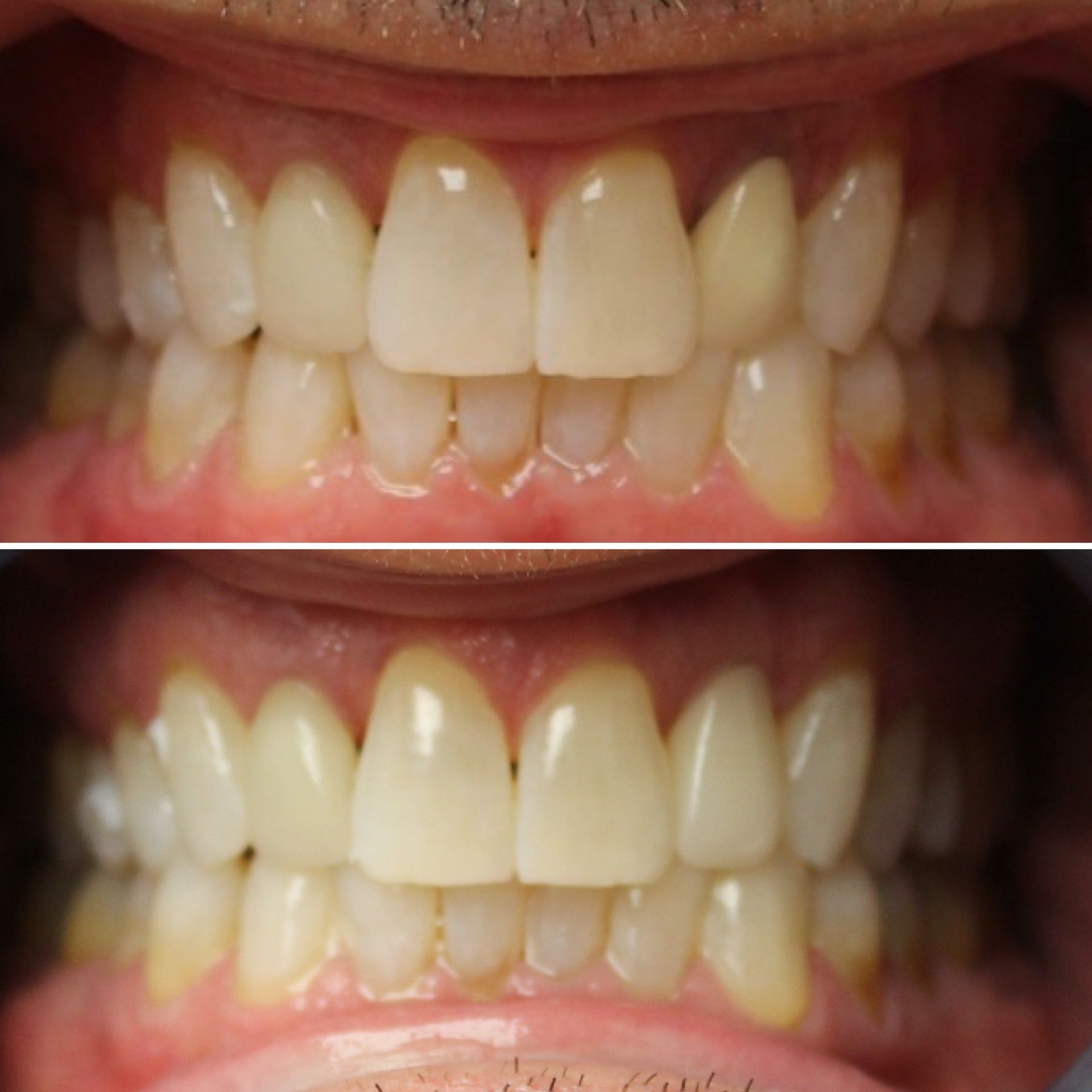 A before and after picture of a person 's teeth.