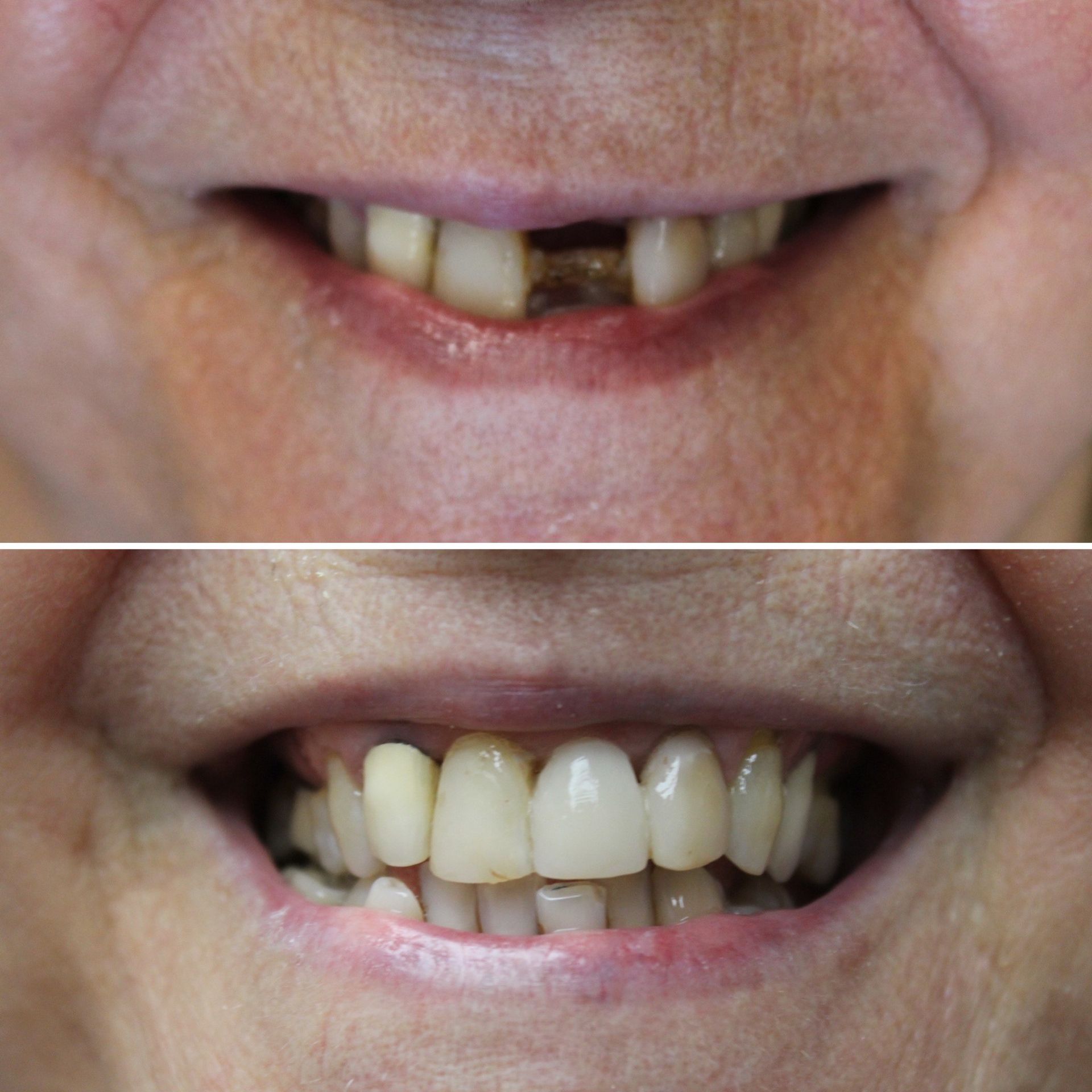 A before and after picture of a woman 's teeth.