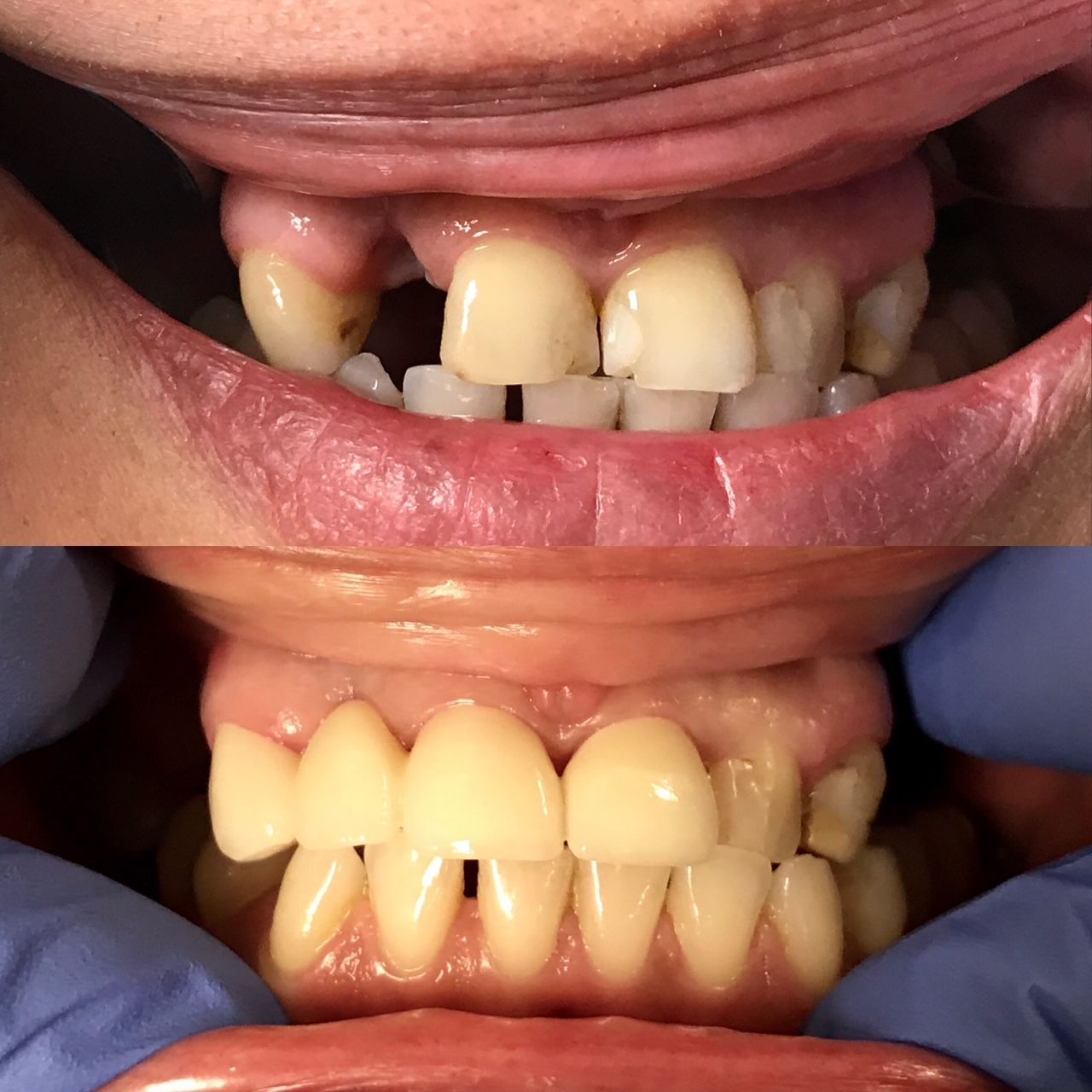 A before and after picture of a person 's teeth