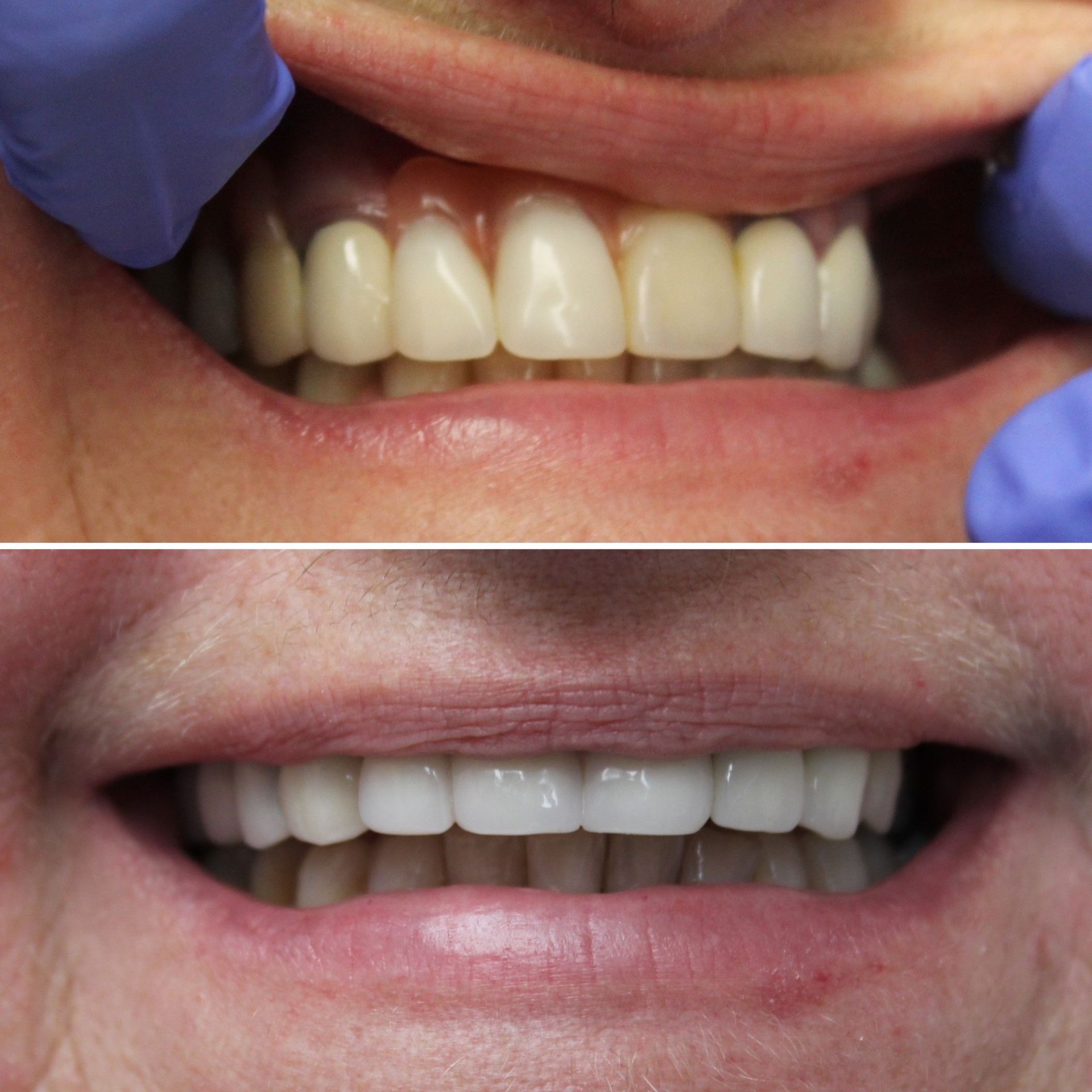 A before and after picture of a person 's teeth.