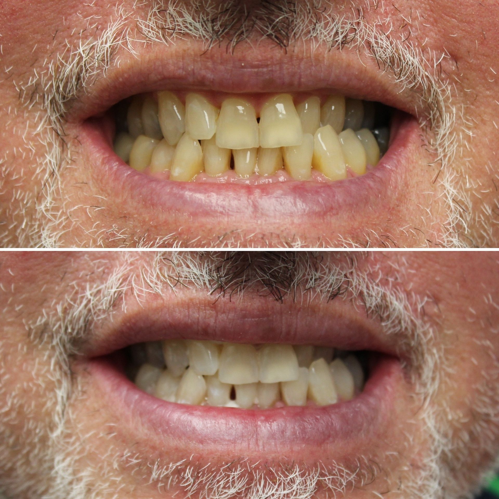 A before and after picture of a man 's teeth